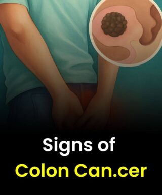 Signs of Colon Cancer