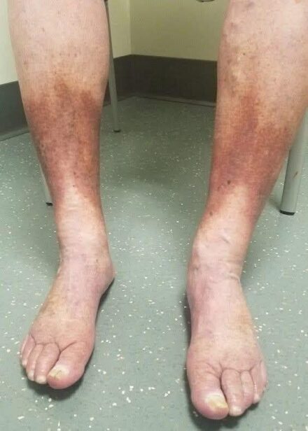 Poor circulation in the feet