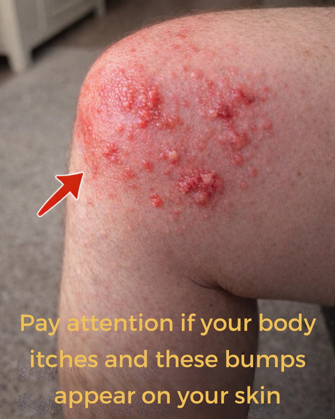 Why Do Hives Suddenly Appear on Your Skin? Surprising Triggers You May Not Expect