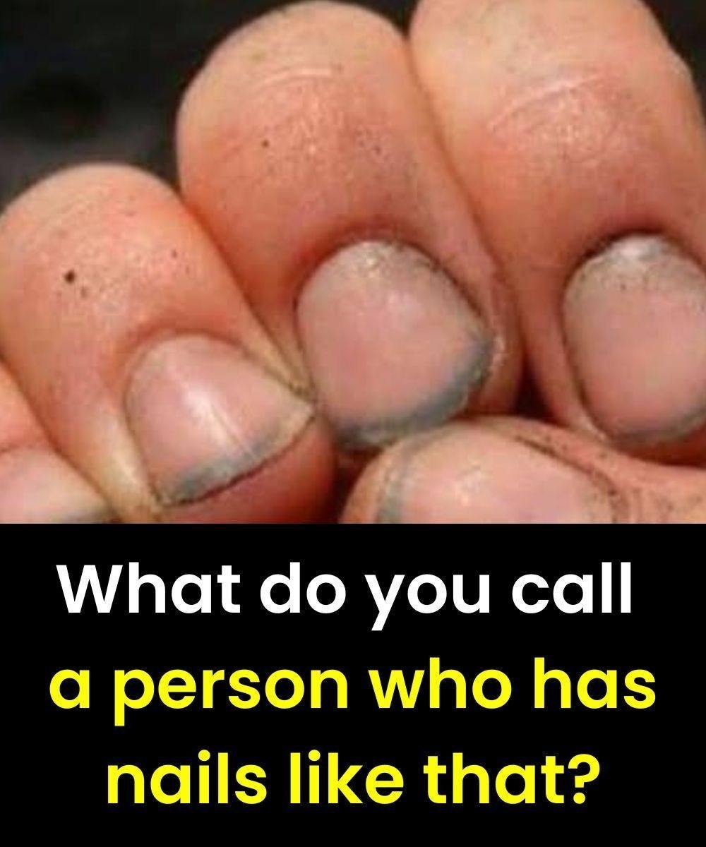 What do you call a person who has nails like that?