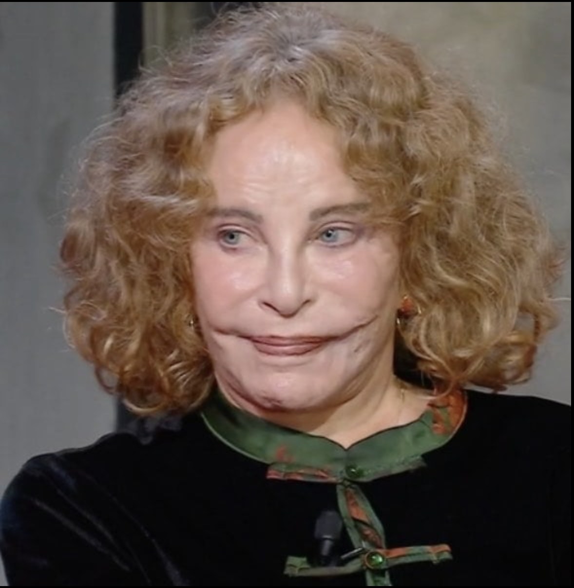 She was once considered the most beautiful woman in the world, but a tragic accident disfigured her face!